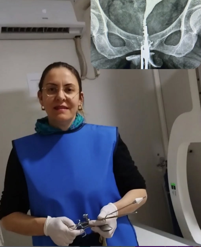 Polikistik Over Sendromu ve Tedavisi